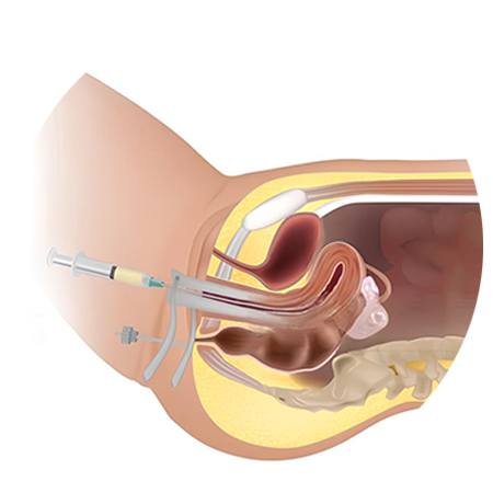 IUI