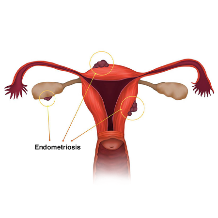 endometriosis